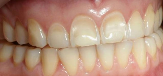 What To Do About Exposed Dentin